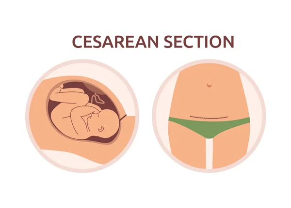 C Section