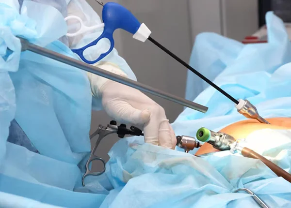 Laparoscopic Sterilisation
