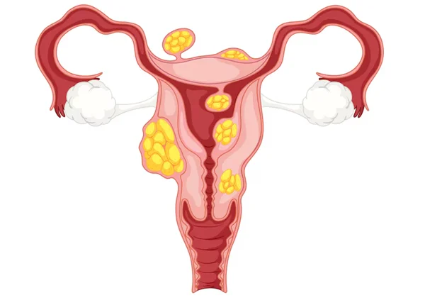 Tubal Ligation
