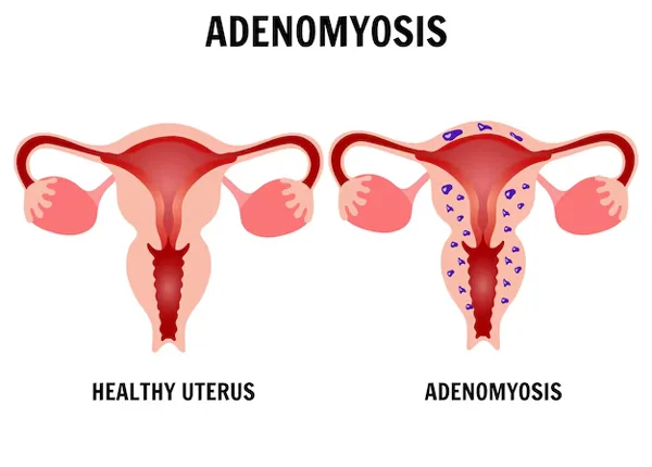 Adenomyosis Treatment
