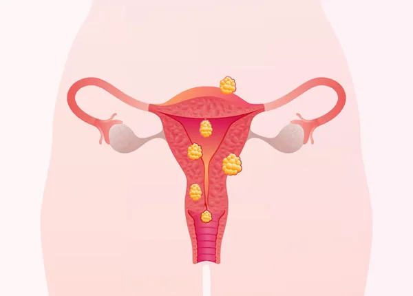 Fibroid Removal Surgery