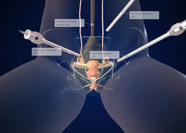 Hysterectomy