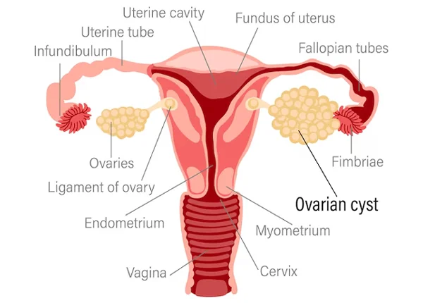 Ovarian Cyst Removal
